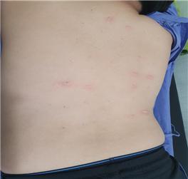 알레르기 피부반응검사 사진입니다.